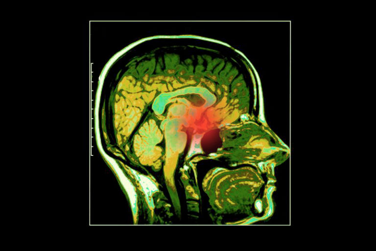 Lanreotide autogel HD e HF per l’acromegalia