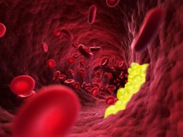 Relazione tra rischio cardiovascolare e colesterolemia controllata con evolocumab