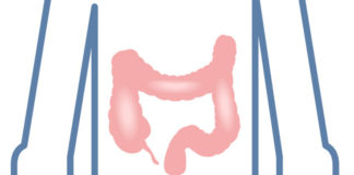 La colite ulcerosa