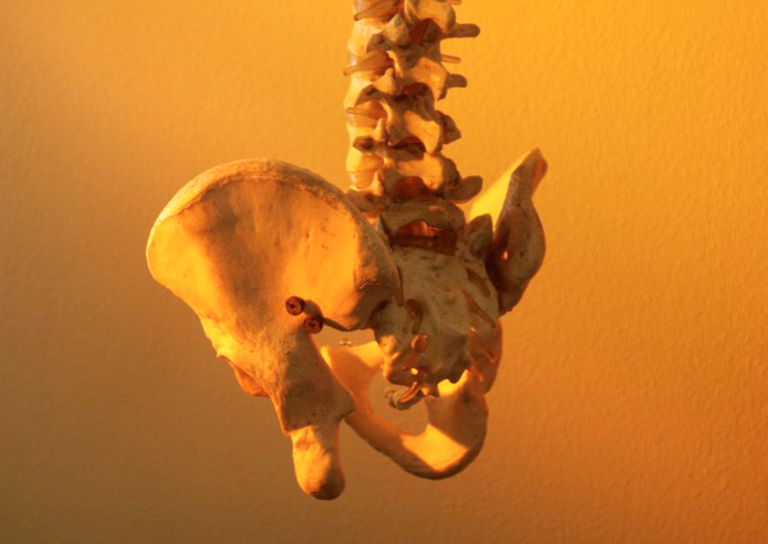 Adroterapia con ioni carbonio per il cordoma dell’osso sacro