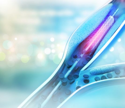 Aggiornamento del Manuale per la classificazione dei dispositivi borderline Stent angioplasty procedure with placing a balloon