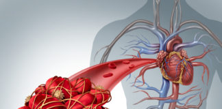 Registro real life europeo su edoxaban per la prevenzione dell’ictus Registro real life europeo su edoxaban per la prevenzione dell’ictus nella FANV