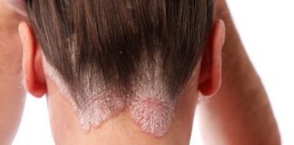 Risultati di due studi su secukinumab per la psoriasi