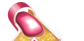 Evolocumab per la prevenzione del rischio cardiovascolare approvato dalla CE