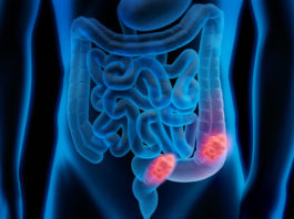 Panitumumab e 5 fluorouracile per il tumore del colon retto