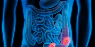 Panitumumab e 5 fluorouracile per il tumore del colon retto