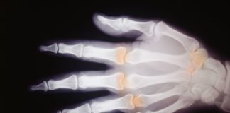 Disponibile in Italia sarilumab per l’artrite reumatoide Disponibile in Italia sarilumab per l'artrite reumatoide