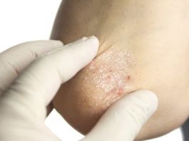Dati su brodalumab vs ustekinumab per la psoriasi