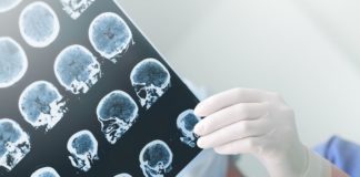 Nuovi dati su teriflunomide per la sclerosi multipla