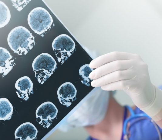 Nuovi dati su teriflunomide per la sclerosi multipla