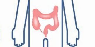 Vedolizumab in formulazione sottocutanea per la colite ulcerosa