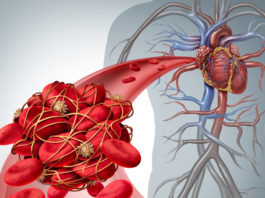 FDA approva rivaroxaban nei pazienti con coronaropatia o arteriopatia periferica La FDA approva rivaroxaban nei pazienti con coronaropatia o arteriopatia periferica per ridurre, in associazione ad aspirina, il rischio di eventi cardiovascolari maggiori
