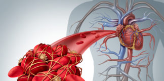 FDA approva rivaroxaban nei pazienti con coronaropatia o arteriopatia periferica La FDA approva rivaroxaban nei pazienti con coronaropatia o arteriopatia periferica per ridurre, in associazione ad aspirina, il rischio di eventi cardiovascolari maggiori