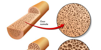 Osteoporosi e fratture da fragilità