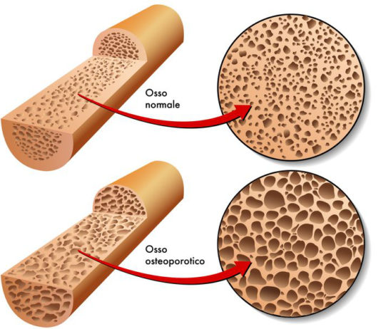 Osteoporosi e fratture da fragilità