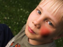 Priority review FDA di dupilumab per la dermatite atopica negli adolescenti Priority review FDA di dupilumab per la dermatite atopica negli adolescenti per i quali le terapie topiche non controllano adeguatamente la malattia o sono sconsigliate