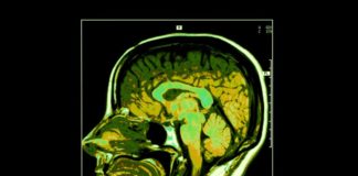 Ictus cerebrale ictus cerebrale