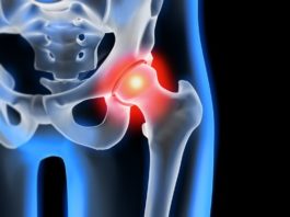 Progetto su un biomateriale per migliorare le protesi all’anca Il progetto EVPRO cerca un biomateriale per migliorare le protesi all'anca che sia in grado di controllare l’infiammazione di migliorare la rigenerazione ossea