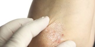 Nuovi dati su secukinumab e ustekinumab per la psoriasi Nuovi dati su secukinumab e ustekinumab per la psoriasi dallo studio CLARITY sono stati presentati al meeting 2019 della American Academy of Dermatology