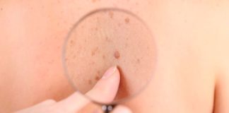 Parere favorevole su cemiplimab per il carcinoma cutaneo carcinoma cutaneo a cellule squamose