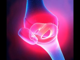 Tumore tenosinoviale a cellule giganti Il tumore tenosinoviale a cellule giganti colpisce le articolazioni sinoviali, le borse e le guaine tendinee