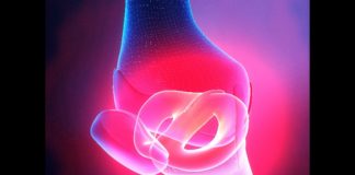 Tumore tenosinoviale a cellule giganti Il tumore tenosinoviale a cellule giganti colpisce le articolazioni sinoviali, le borse e le guaine tendinee