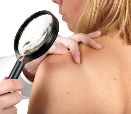 AIC europea a cemiplimab per il carcinoma cutaneo CS avanzato