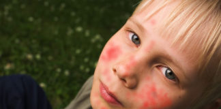 Dupilumab per la dermatite atopica grave nei bambini