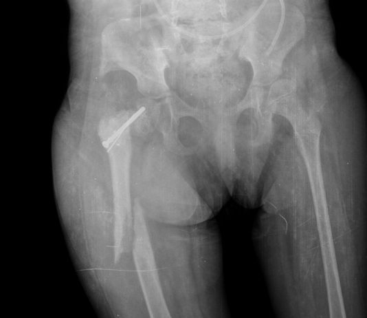 Romosozumab per l’osteporosi