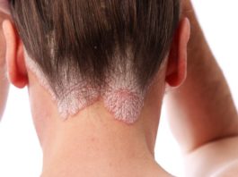 Risankizumab per la psoriasi a placche
