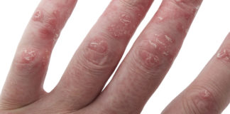 Rimborsabile in Italia brentuximab vedotin per il linfoma cutaneo CTCL Rimborsabile in Italia brentuximab vedotin per il linfoma cutaneo