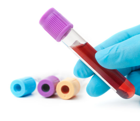 Rimborsabile in Italia la terapia CAR-T axicabtagene ciloleucel