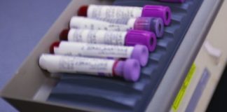 Blinatumomab vs chemioterapia nella prima recidiva di LLA-B pediatrica Blinatumumab leucemia