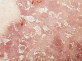 Bimekizumab per la psoriasi a placche da moderata a severa Lo studio di fase III su bimekizumab in psoriasi ha raggiunto tutti gli endpoint, dimostrando un’efficacia significativamente maggiore versus placebo e ustekinumab