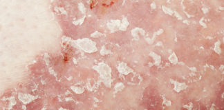 Bimekizumab per la psoriasi a placche da moderata a severa Lo studio di fase III su bimekizumab in psoriasi ha raggiunto tutti gli endpoint, dimostrando un’efficacia significativamente maggiore versus placebo e ustekinumab