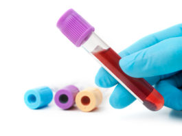Dati su carfilzomib e desametasone in associazione con daratumumab per il MM Dati su carfilzomib e desametasone in associazione con daratumumab per il MM