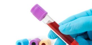 Dati su carfilzomib e desametasone in associazione con daratumumab per il MM Dati su carfilzomib e desametasone in associazione con daratumumab per il MM