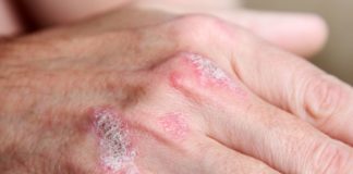 Evidenze real-world su secukinumab per la psoriasi nella pratica clinica Evidenze real-world nella pratica clinica confermano l’elevata efficacia, la risposta a lungo termine e il profilo di sicurezza di secukinumab