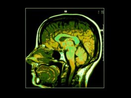 Consensus per i nuovi criteri diagnostici della sclerosi laterale primaria Consensus per i nuovi criteri diagnostici della sclerosi laterale primaria (PLS) raggiunta con contributo della ricerca italiana