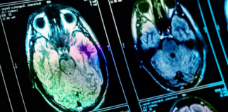 Prevenire le reazioni di ipersensibilità ai mezzi di contrasto