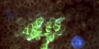 Cancro della mammella, nuovi farmaci sfruttando il virus Herpes simplex