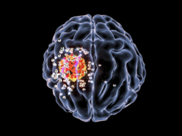 Glioblastoma, un contributo alla ricerca dalla nanomedicina