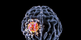 Glioblastoma, un contributo alla ricerca dalla nanomedicina