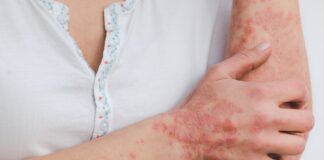 Psoriasi: risultati promettenti per deucravacitinib