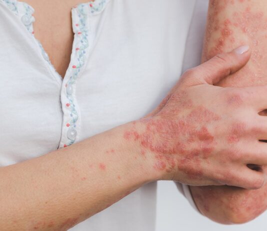 Psoriasi: risultati promettenti per deucravacitinib