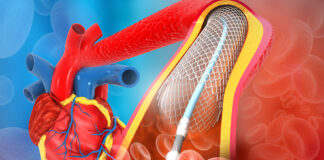 Scompenso cardiaco, risultati positivi per empagliflozin