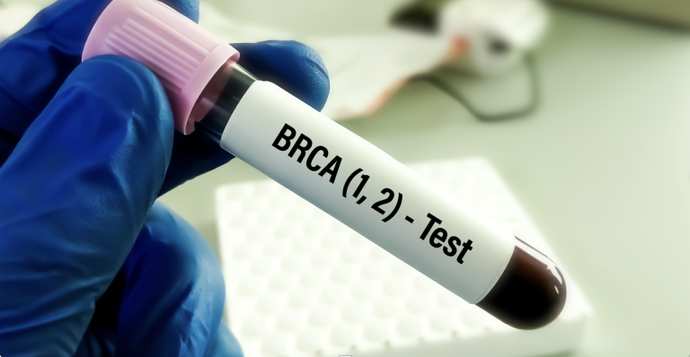 Tumore al seno metaplastico, rivelata l’origine ereditaria