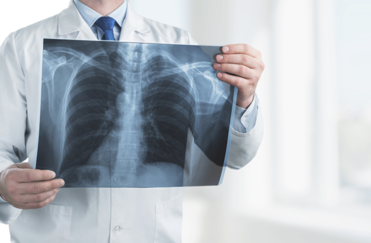 AIFA, accesso allargato per i medicinali per la fibrosi cistica