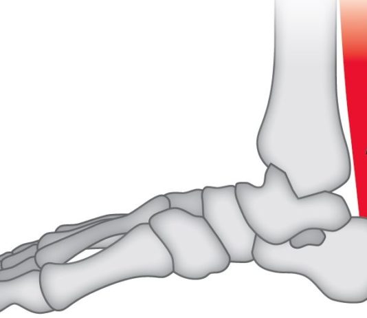 Tendinopatia d'Achille, IOR arruola pazienti per sperimentazione