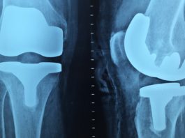 Protesi totale di ginocchio: efficacia della crioterapia